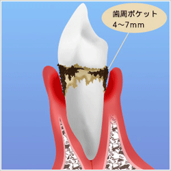 歯周病って？