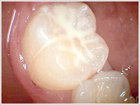 奥歯の虫歯はシーラントで予防！